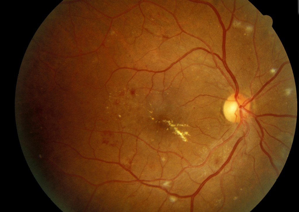 Clinically significant macular edema Endotext